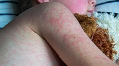 ni-records-sharp-rise-in-measles-cases