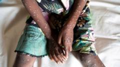 who-declares-mpox-global-health-emergency