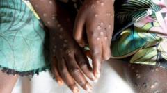 mpox-not-new-covid-and-can-be-stopped,-expert-says