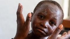 how-worried-should-we-be-about-mpox?